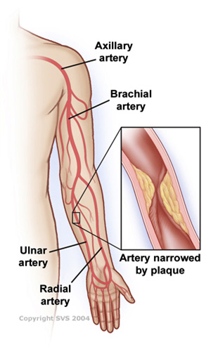 Arm Artery Disease | SIU School of Medicine