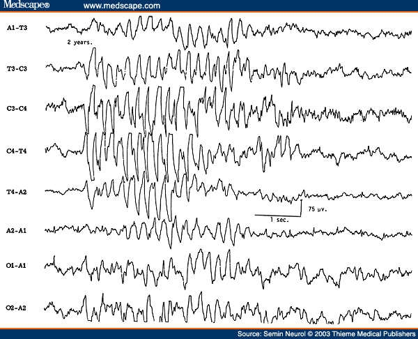 Figure 1. EEG of a 2-year-old child with very prominent spikelike vertex sharp transients.