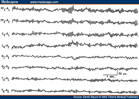 Figure 10. EEG of a 77-year-old comatose patient following cardiopulmonary arrest 4 days previously, showing "alpha coma pattern." Patient died after 2 days. 