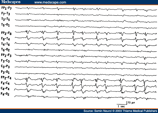 Figure 11. EEG of a 65-year-old patient with Herpes simplex encephalitis, showing periodic epileptiform discharges occurring over the right temporal region every 1 to 2 seconds.