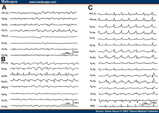 Figure 13. Serial EEGs of a 62-year-old patient with Creutzfeldt-Jakob disease. The first EEG (A), obtained 2 months after the onset of dementia and progressive right hemiparesis, shows left-sided delta activity. EEG 2 weeks later (B) shows periodic lateralized epileptiform discharges over the left hemisphere, and an EEG taken 5 months after the onset of illness (C) shows typical bisynchronous high-amplitude periodic complexes superimposed on "flat" background. Myoclonic jerks monitored on the last channel are synchronous to the periodic complexes. 