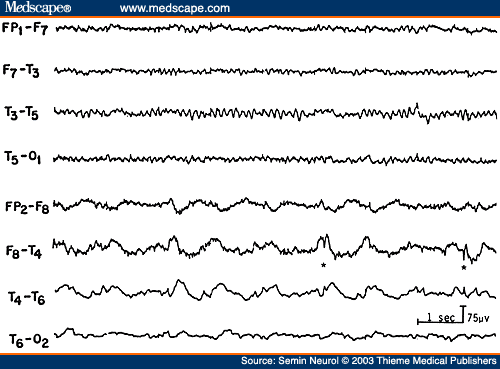 Figure 15. EEG of a 43-year-old patient with right temporal glioma, showing polymorphic delta activity and low-amplitude spike discharges (*) over the right temporal region. 