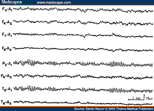 Figure 16. EEG of a 16-year-old patient with Sturge-Weber syndrome of the right hemisphere, showing total absence of rhythmic activities over the entire affected hemisphere.