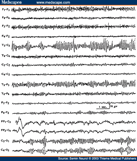 Figure 18. EEG of a 47-year-old patient with history of previous left craniotomy, showing breach rhythm in the left temporocentral region.