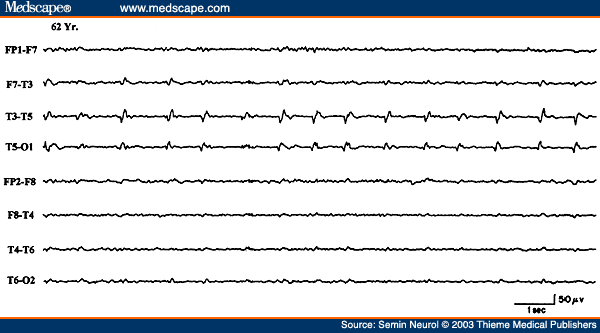 Figure 19. EEG of a 62-year-old patient with acute onset of right hemiparesis, aphasia, and right focal motor seizures, showing periodic lateralized epileptiform discharges over the right posterior temporal region.