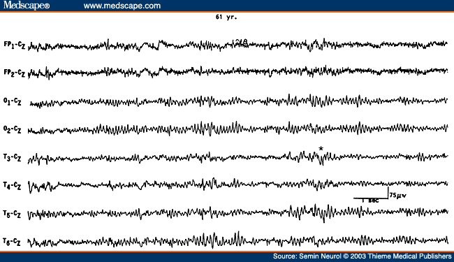 Figure 2. EEG showing intermittent slow wave transients (*) in a 61-year-old subject.