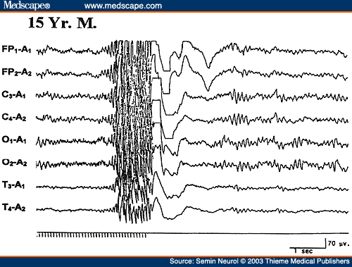 Figure 20. An EEG of a 15-year-old patient with primary generalized epilepsy, showing prolonged (self-sustained) photoparoxysmal response.