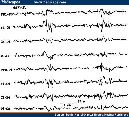 Figure 21. EEG of a 46-year-old patient with primary generalized epilepsy, showing atypical generalized bisynchronous spike wave activity.