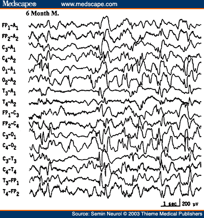 Figure 22. EEG of a 6-month-old infant with developmental delay and infantile spasms, showing typical hypsarrhythmic pattern.