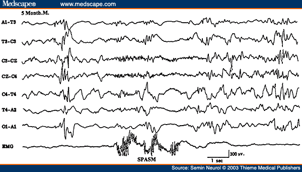 Figure 23. EEG of a 5-month-old infant, showing electrodecremental response during an infantile spasm monitored on the last channel.