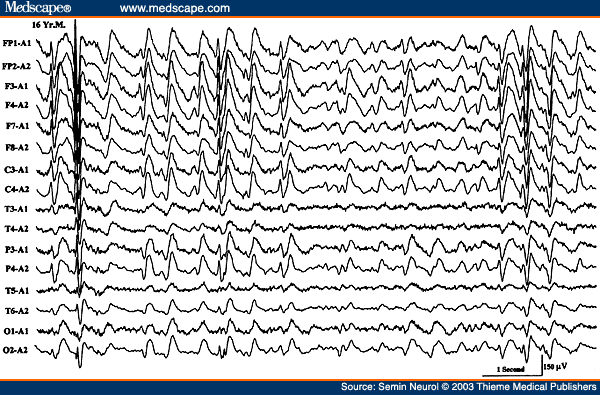 Figure 24. EEG of a 16-year-old child with mental retardation and tonic seizures, showing slow spike wave activity superimposed on a slow background.