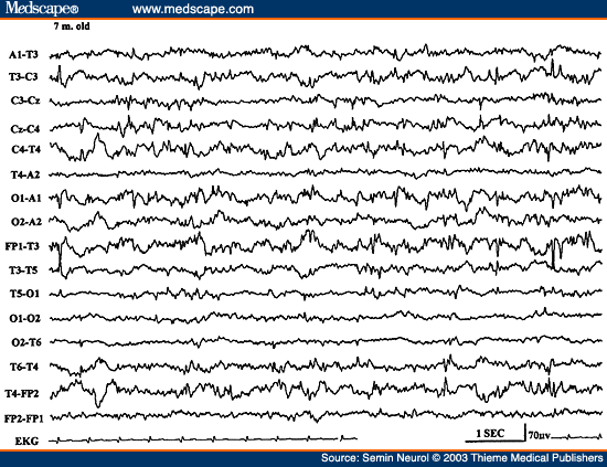 Figure 25. EEG of a 7-month-old child, showing independent multifocal spike discharges.