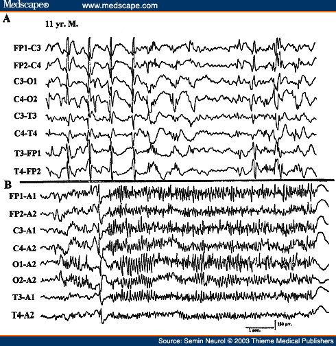 Figure 26. EEG of an 11-year-old patient with Lennox-Gastaut syndrome, showing generalized paroxysmal fast activity (B).