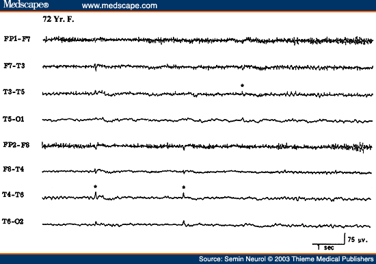 Figure 29. EEG of a 72-year-old patient, showing benign epileptiform transients of sleep (small sharp spikes).