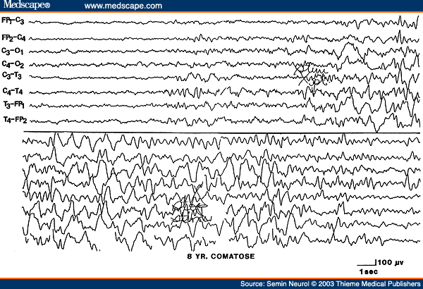 Figure 3. EEG of an 8-year-old child with hemolytic anemia and uremia, showing paradoxical activation characterized by increased delta slowing induced by painful stimulation. 