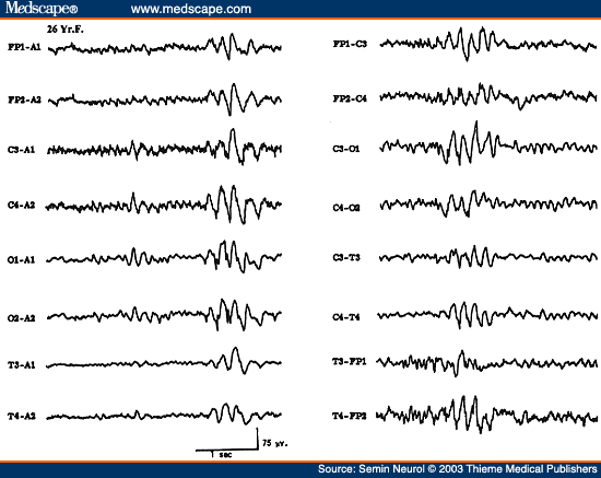 Figure 30. EEG of a 26-year-old patient, showing 6 Hz spike wave paroxysms (phantom spike wave).