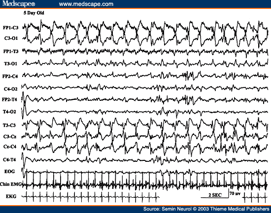 Figure 33. EEG of a 5-day-old neonate, showing focal ictal pattern characterized by rhythmic sharp waves in the left Rolandic region.