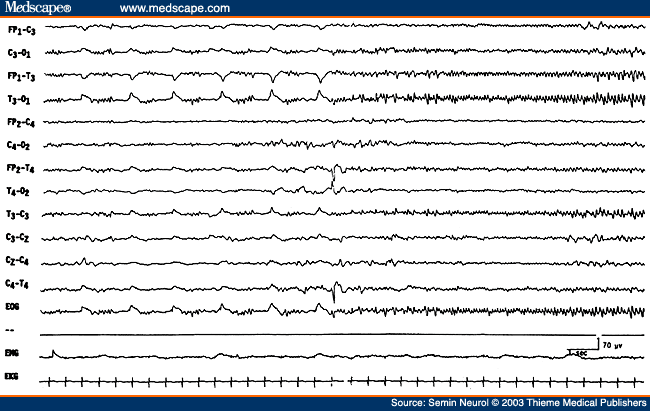 Figure 35. EEG of a 3-day-old comatose neonate with history of seizures, showing an electrographic "alpha band" seizure pattern without clinical accompaniment.