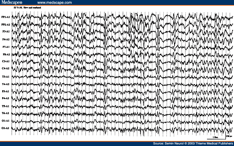 Figure 36. EEG of a 53-year-old man with one day history of acute confusion and slowness of motor responses, showing almost continuous generalized spike wave activity.