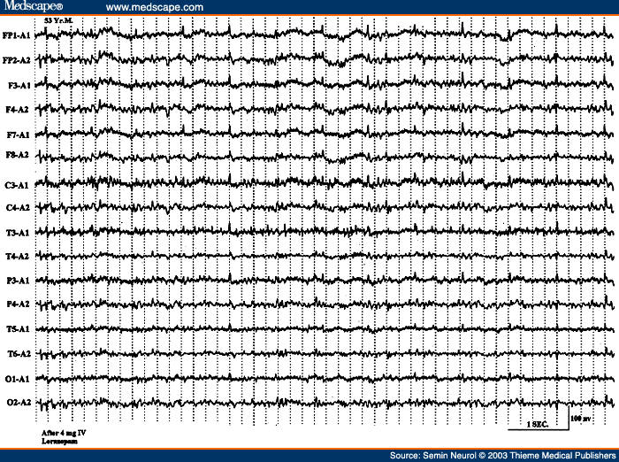 Figure 37. EEG of the same patient seen in Figure 36 following 4 mg of intravenous lorazepam, showing disappearance of all paroxysmal activity and mental clearing, highly suggestive of nonconvulsive status epilepticus.