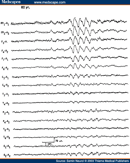 Figure 4. EEG of an 82-year-old patient with recent history of lethargy and confusion, showing frontal intermittent rhythmic delta activity.