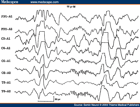 Figure 6. EEG of a 16-year-old comatose patient with Reye's syndrome, showing 14 cps positive spikes.