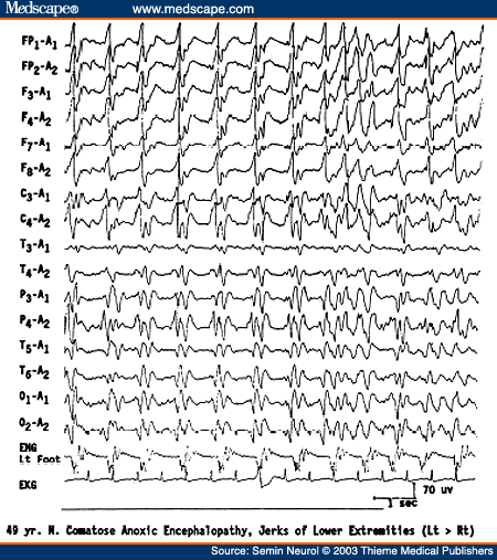 Figure 8. EEG of a 49-year-old comatose patient following severe anoxic encephalopathy, showing bisynchronous periodic epileptiform discharges synchronous with jerks of the left lower extremity monitored on a separate channel.