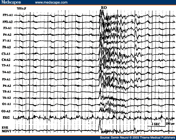Figure 9. EEG of a 75-year-old patient with severe anoxic encephalopathy, showing suppression-burst pattern. During the burst activity there is opening of the eyes; eye movements monitored in the last channel.