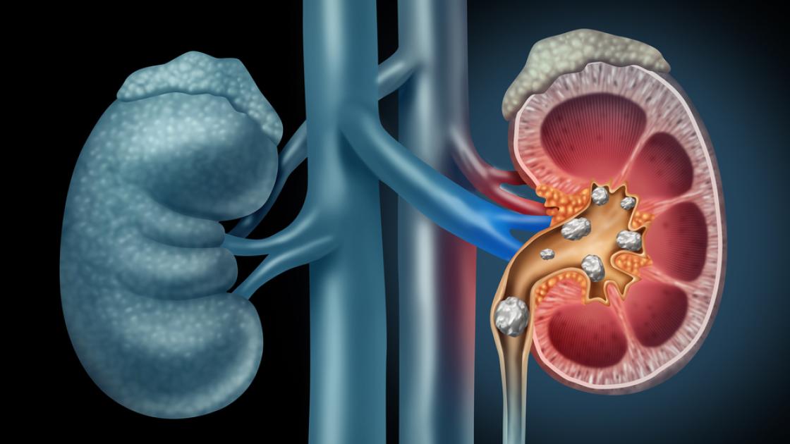 blog-kidney-stones