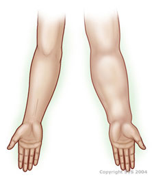 Lymphedema | SIU School of Medicine