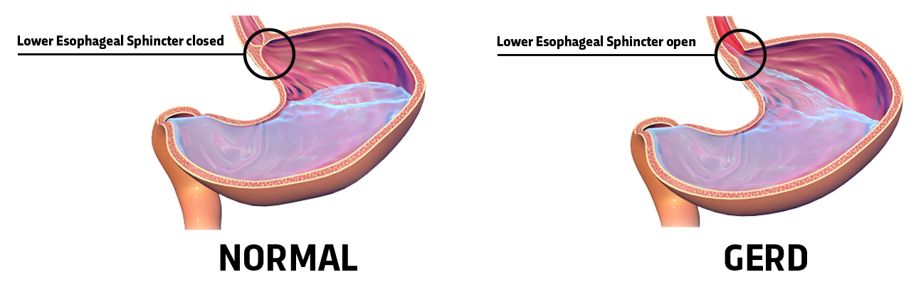 Gastroesophageal Reflux Disease - (GERD) | SIU School of ...